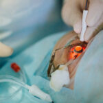 cataracts surgery