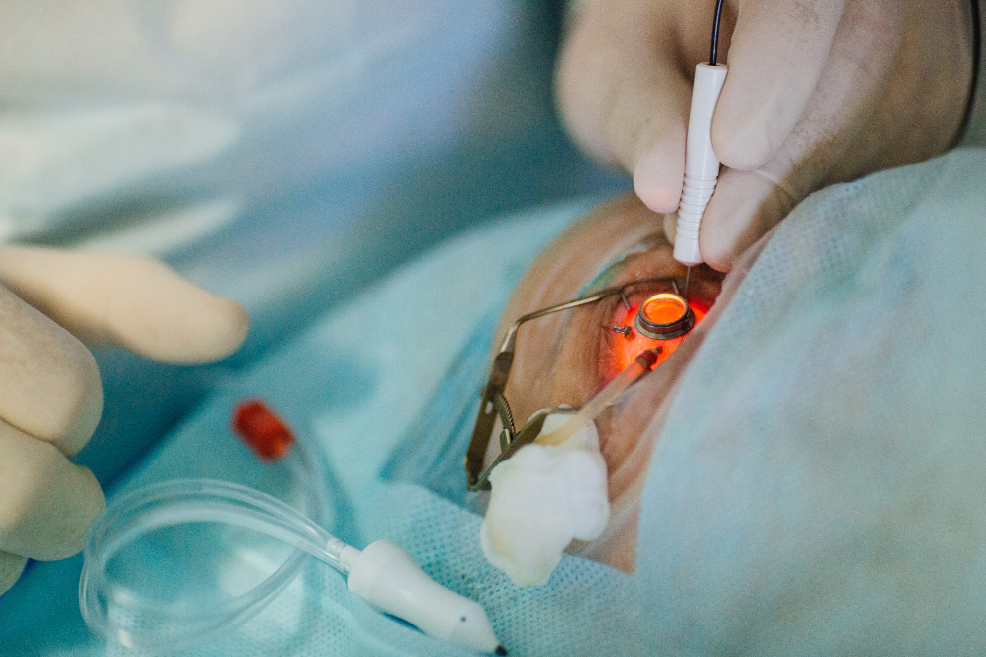 cataracts surgery